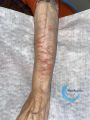 Eczéma craquelé30.jpg