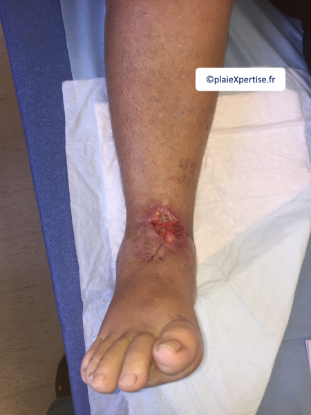 Fichier:Cou de pied14.png