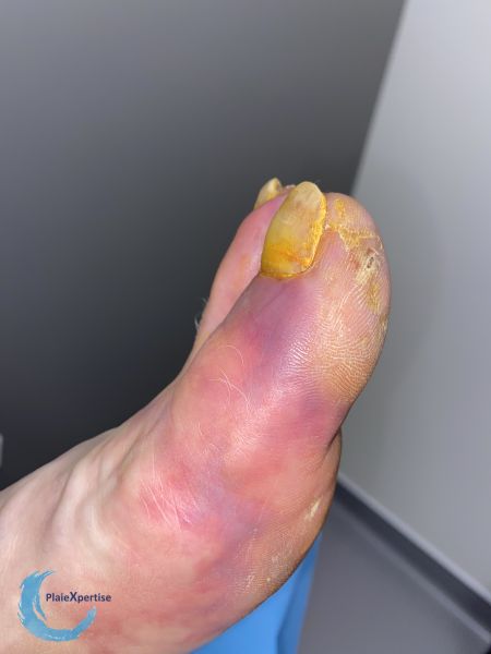 Fichier:Embols de cristaux de cholestérol13.jpg