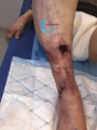 Calciphylaxie4.png