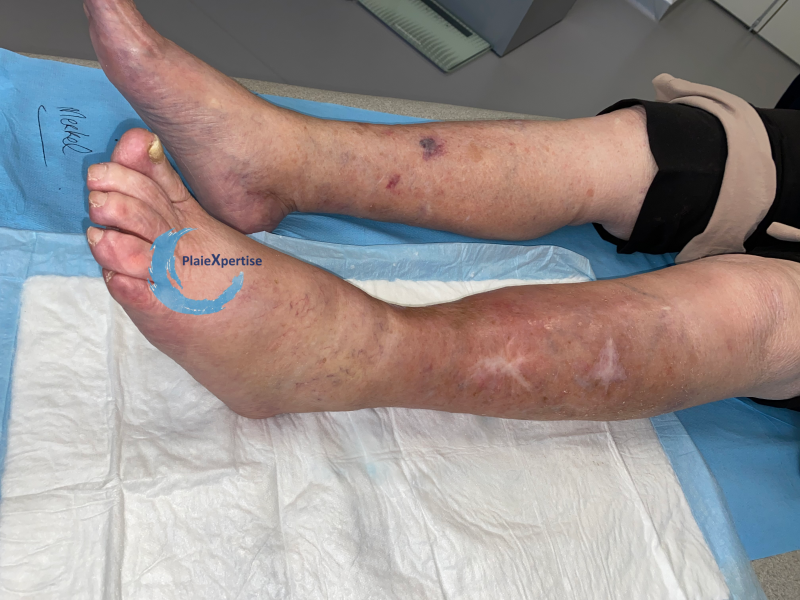 Fichier:Dermatoporose33.png