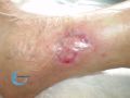 Epidermisation9.jpg