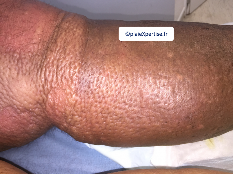 Fichier:Hypodermite chronique11.png
