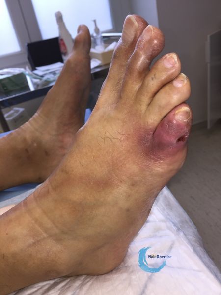 Fichier:Pied infecté46.jpg