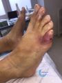 Pied infecté46.jpg