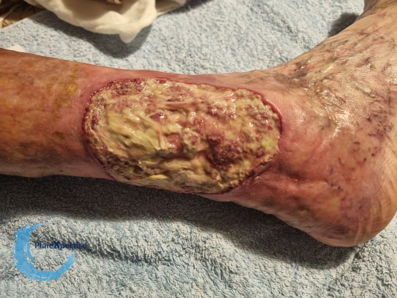 Fichier:Pyoderma gangrenosum39.jpg