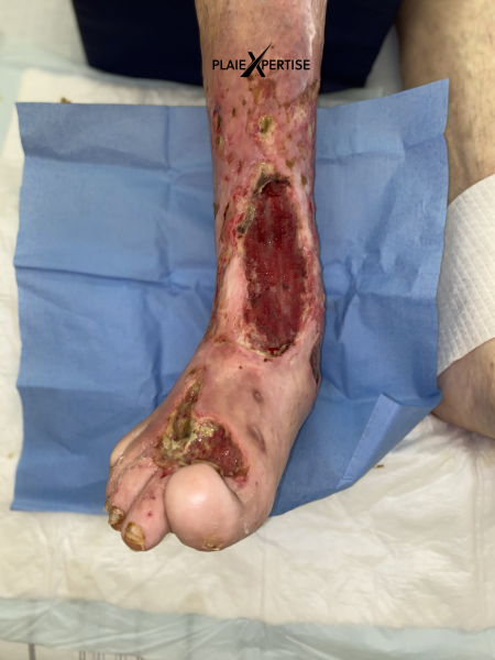 Fichier:Tissu de granulation inflammatoire25.png