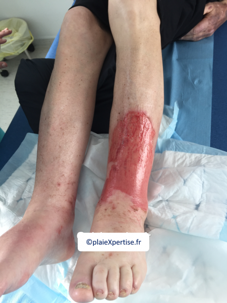 Fichier:Erosion en nappe10.png