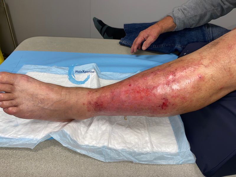 Fichier:Eczéma149.jpg