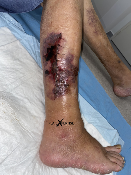 Fichier:Angiodermite typique51.png