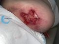 Calciphylaxie14.jpg
