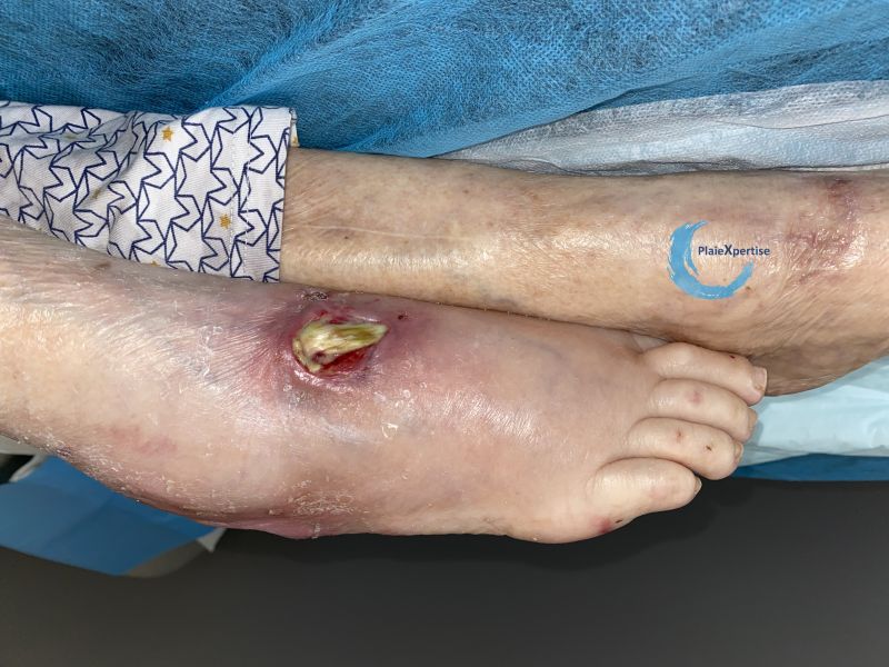 Fichier:Cou de pied82.jpg