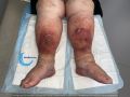 Dermite d'irritation231.jpg