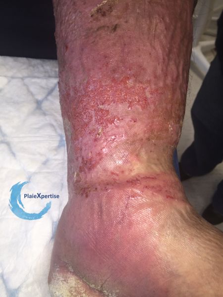 Fichier:Lymphoedème46.jpg