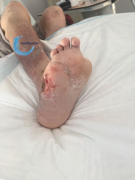 Fichier:Pied déformé12.jpg