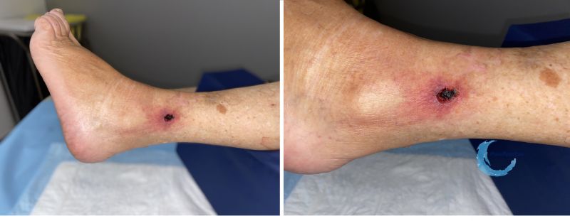 Fichier:Angiodermite typique125.jpg