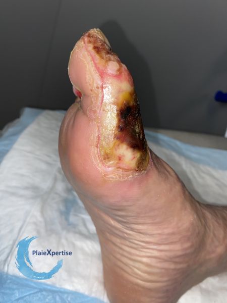 Fichier:Brulure40.jpg