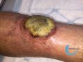 Pyoderma gangrenosum30.jpg