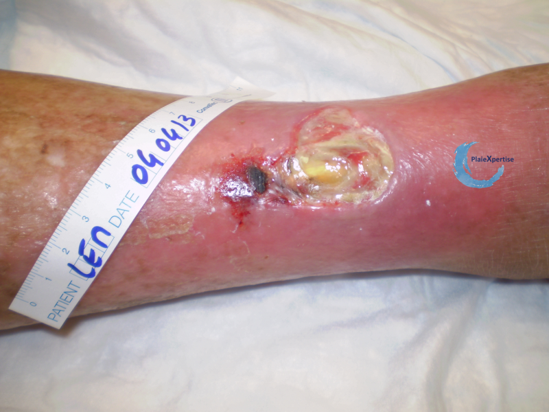 Fichier:Angiodermite typique66.png