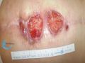 Epidermisation10.jpg