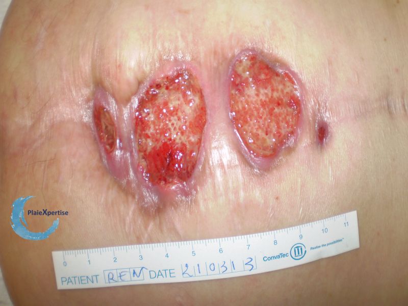 Fichier:Epidermisation10.jpg