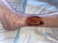Angiodermite typique129.jpg