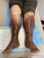 Dermiteocre47.png