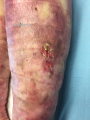 Epidermolyse bulleuse acquise3.png