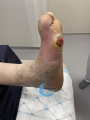 Pied de Charcot6.png