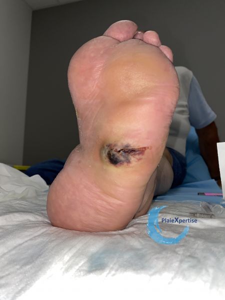 Fichier:Pied de Charcot24.jpg