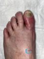 Pied infecté11.jpg