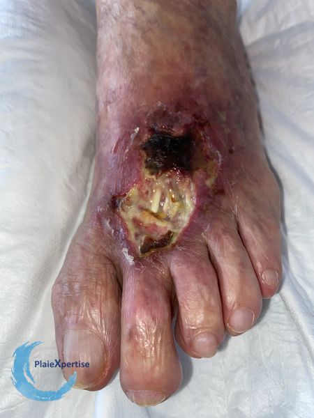 Fichier:Tendon nécrotique humide75.jpg