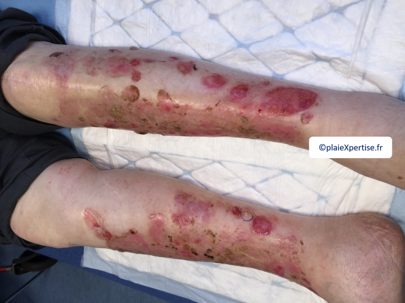 Fichier:Erosion ponctiforme plus 5 mm2.png