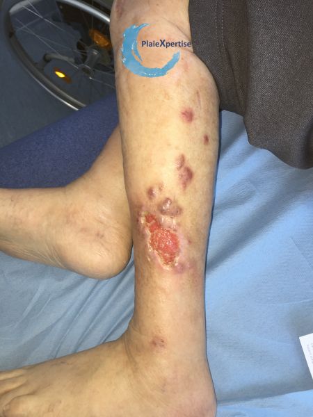 Fichier:Pyoderma gangrenosum35.jpg