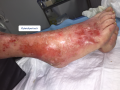Eczéma2.png