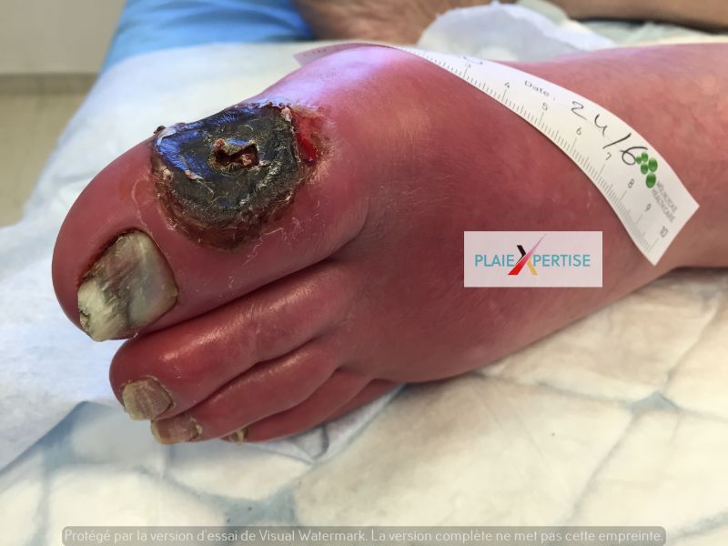 Fichier:Nécrose sèche Pied 4.jpg