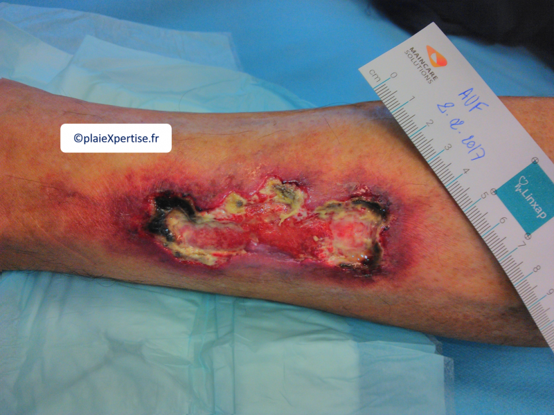 Fichier:Angiodermite typique8.png