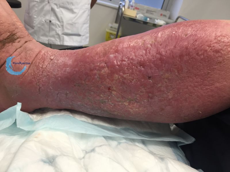 Fichier:Hypodermite chronique49.jpg