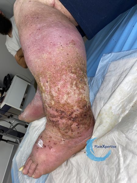 Fichier:Lymphoedème60.jpg