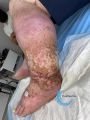Lymphoedème60.jpg