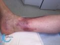 Nécrobiose lipoïdique21.jpg