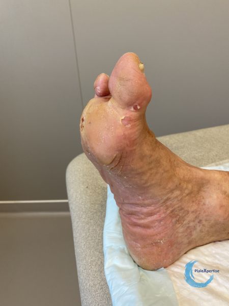Fichier:Avant pied rond2.jpg