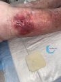 Dermite d'irritation104.jpg