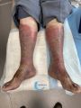 Dermiteocre81.jpg
