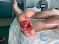 Amputation10.jpg