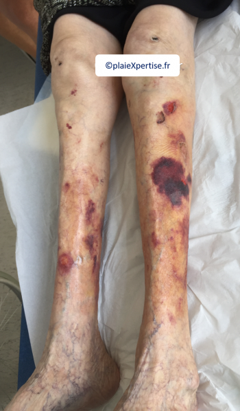 Fichier:Dermatoporose7.png