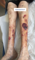 Dermatoporose7.png