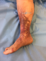 Dermiteocre34.png