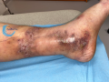 Dermiteocre62.png