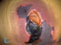 Calciphylaxie21.jpg